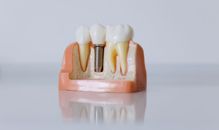 Dental Implants in Calistoga- Calistoga Dental Group