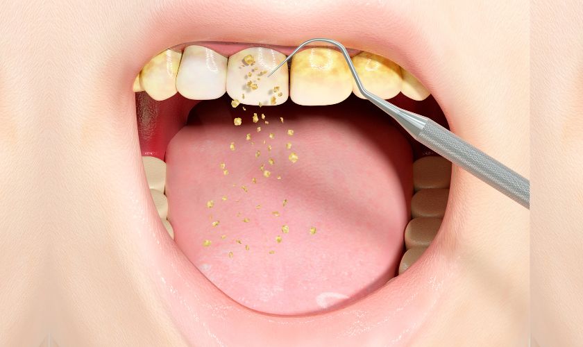 tartar in teeth getting removed by a dentist in Calistoga